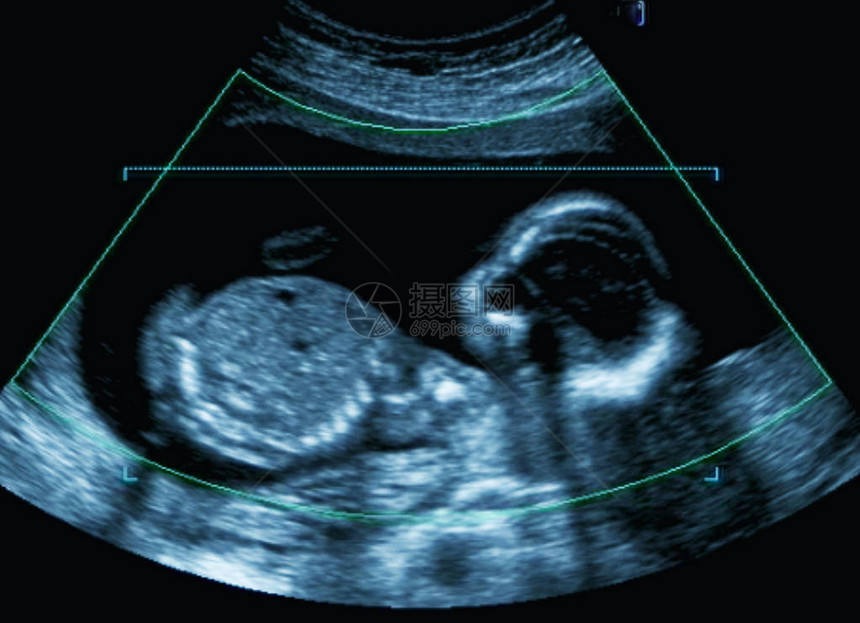 怀孕期间母亲子宫超声图片