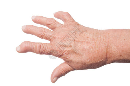 因类风湿关节炎变形的老妇人的手背景图片