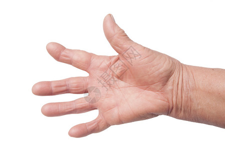 因类风湿关节炎变形的老妇人的手图片