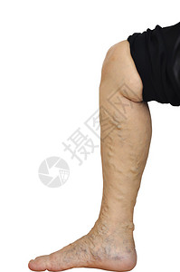 白色背景的亚洲老妇腿静脉曲张图片