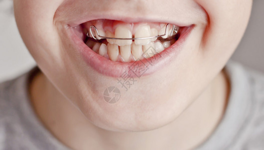 带牙套的快乐青少年口腔正畸学图片