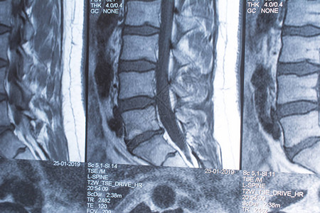 腰椎磁共振断层扫描图片