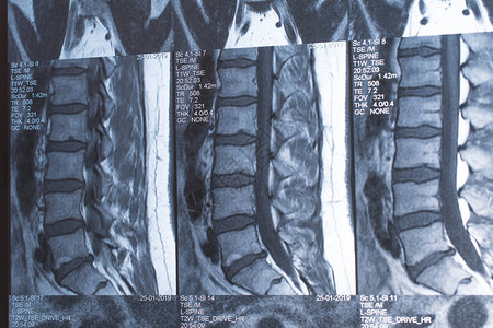 腰椎磁共振断层扫描图片