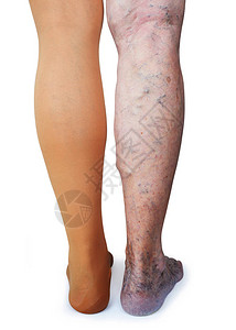 白背景的老太婆腿上的血栓状丝袜孤图片
