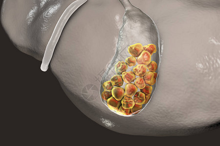 胆道镜显示肝脏和胆囊与石设计图片