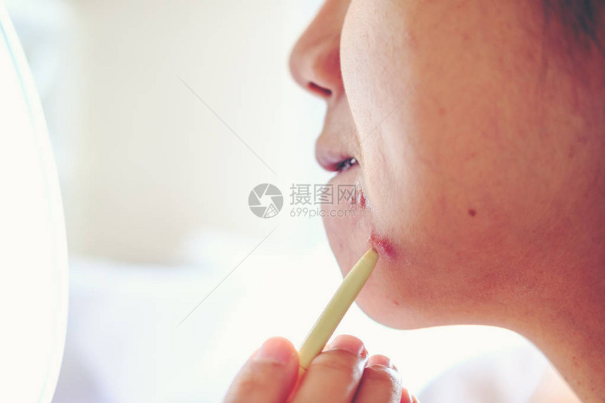 女孩将芦荟凝胶涂在有痤疮疤痕的问题皮肤上图片