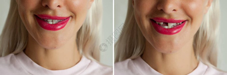断牙和种植牙前后图片