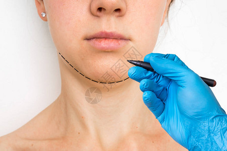 整形外科医生在患者下巴上画线图片