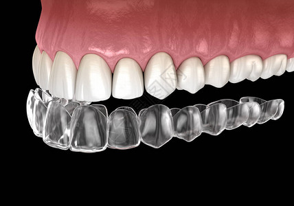 外观牙套或隐形保留人医学上准确的图片