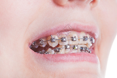 牙齿上的正畸牙套在治疗期间关闭图片