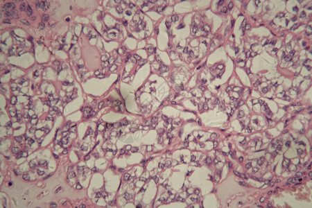 显微镜下患有癌症的人类甲状腺细胞图片