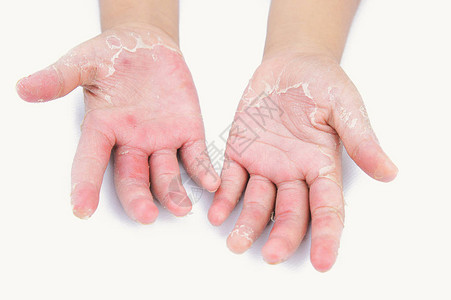皮炎儿童手指皮肤感图片