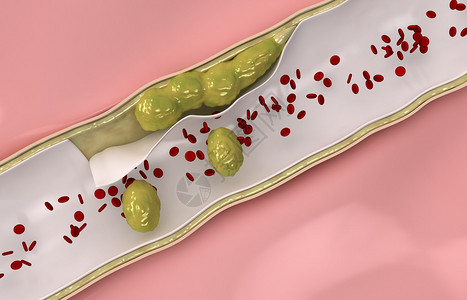 栓子冠胆固醇通过循环系统设计图片