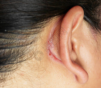 耳后伤口耳朵皮肤背景图片