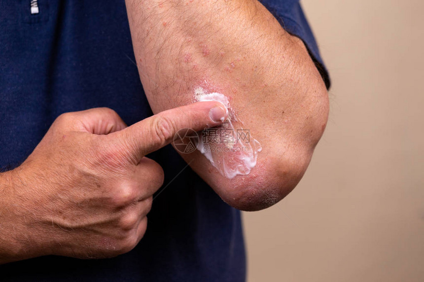 使用软膏作为药物剂型治疗皮肤病的概念照片患者在肘部区域特写的皮肤上引起医学治疗软膏稠度图片