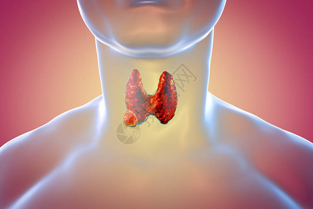 甲状腺癌3D图解显示人体内设计图片