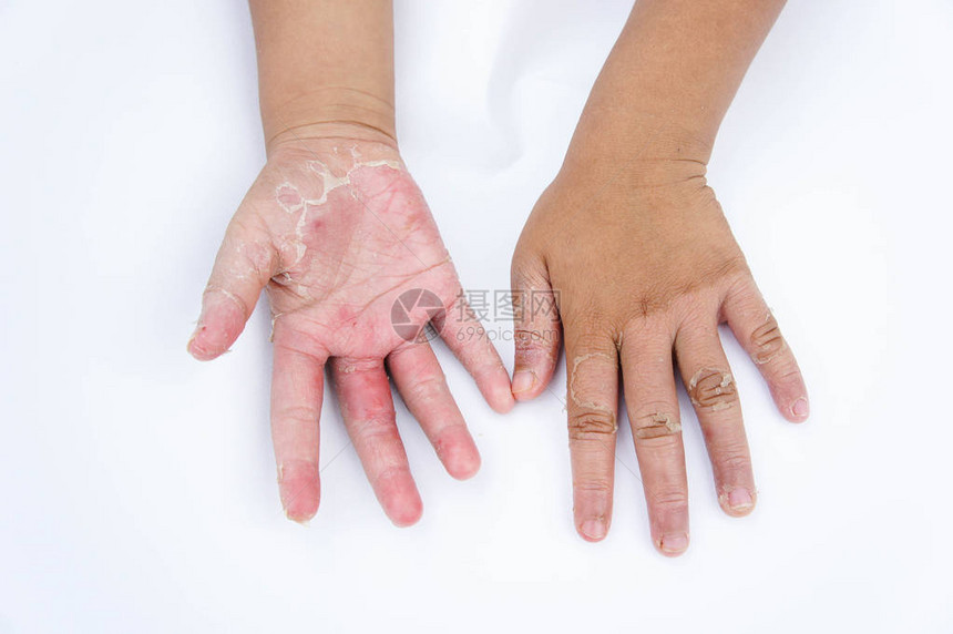 干手皮革接触皮炎真菌感染