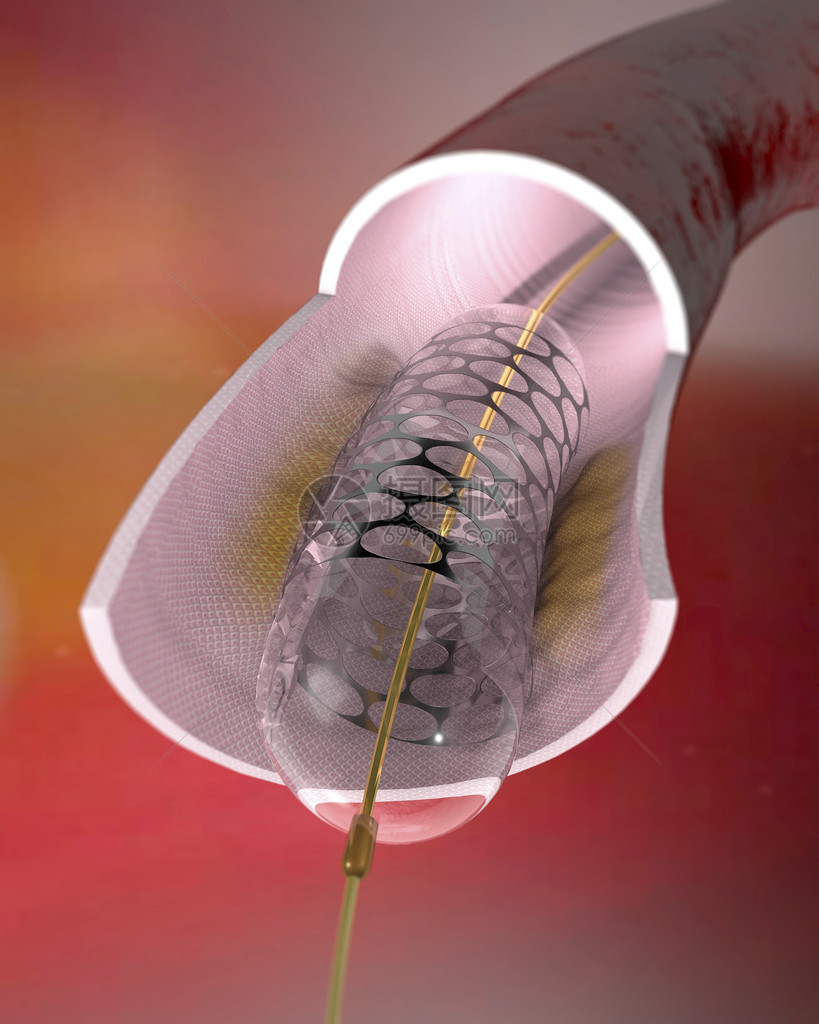动脉和里面的支架支架是植入狭窄动脉以保持动脉畅通的网状管带有支架的球囊导管通常用于血管成形术以扩图片