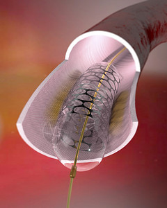 动脉和里面的支架支架是植入狭窄动脉以保持动脉畅通的网状管带有支架的球囊导管通常用于血管成形术以扩插画
