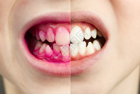 工作中显示片剂的前后效果关闭了年轻男孩牙齿的照片背景图片