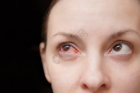 关闭受结膜炎或流感冒或过敏影响的女一只恼怒的红血和健康眼睛疾病和治疗的概念复制广告空间背景图片