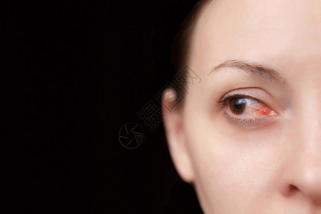 受结膜炎或流感后感冒或过敏影响的妇女的烦恼红血眼紧贴在一旁背景图片