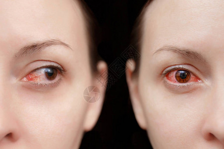 关闭受结膜炎或流感冒过敏症影响的女恼怒的红血眼一边看相机疾病治疗理念复制空间广告工背景图片