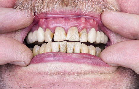 牙齿和牙龈概念的问题老年人的健康问题之一背景图片