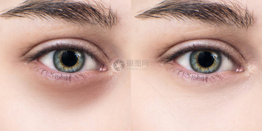 在接受化妆治疗之前和之后眼睛下有瘀图片