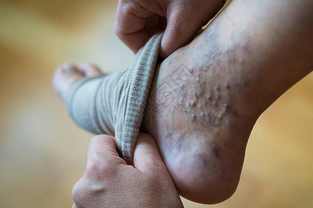 一位女士将弹力袜套在她患有静脉曲张的腿上图片