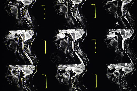 颈椎MRI图片