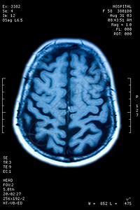 脑共振照片图片