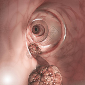鱼鳞病肠壁的内部视图结直肠癌CRC肠癌结肠癌或直肠癌侵入或扩散到身体其他部位的细胞异常生长设计图片