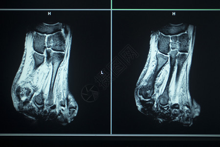 MRI磁共振成像核扫描测试结果脚图片
