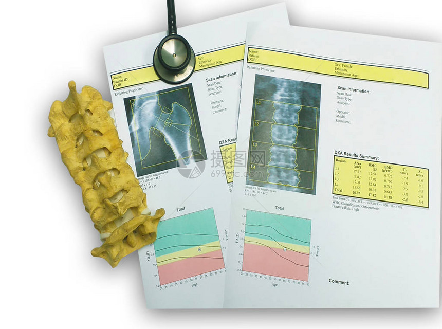顶视图骨密度和腰椎结果骨质疏松症骨质疏松症是一种削弱骨骼的情况图片