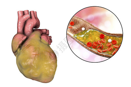 3D插图心血管疾病和天体硬化症的概念形象三维图解图片