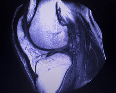 磁共振成像MRI膝盖后部角中枢断裂的眼泪图片