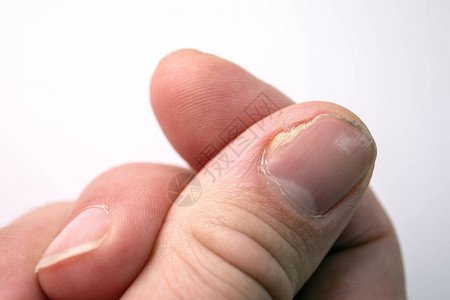 关闭拇指上的指甲真菌感染指甲手真菌感染指甲真菌感图片