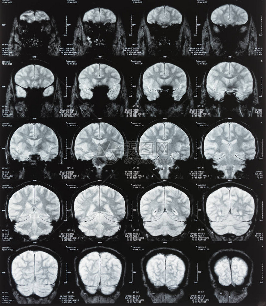 磁共振成像与大脑的ct扫描图片