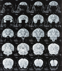 磁共振成像与大脑的ct扫描图片