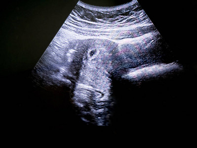孕妇第5周胚胎B超图片