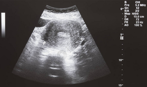 孕妇婴儿的超声波图片