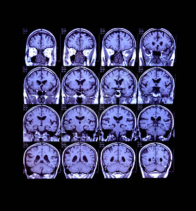计算脑囊中央神经系统医学测试X光MRI图片