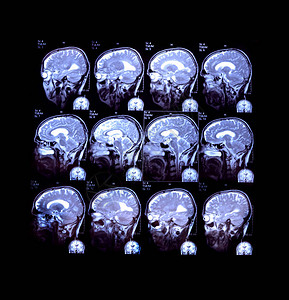 脑磁共振成像颅骨医学分析X射线MRICT图片