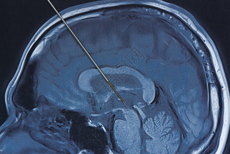 帕金森手术中丘脑底核脑记录的概念人脑磁共振成像图片