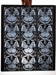 脑部核磁共振成像扫描图像图片