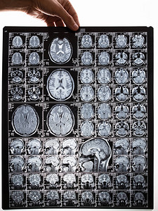 脑部核磁共振成像扫描图像图片