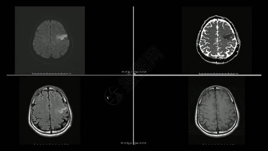 左前额叶的左侧颈部脑切裂磁共振图背景图片