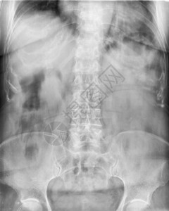 X射线腰骶椎和骨盆检查扫描图片