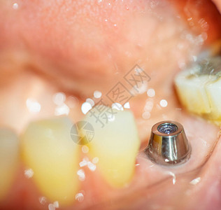 下巴牙科植入情况的详图片